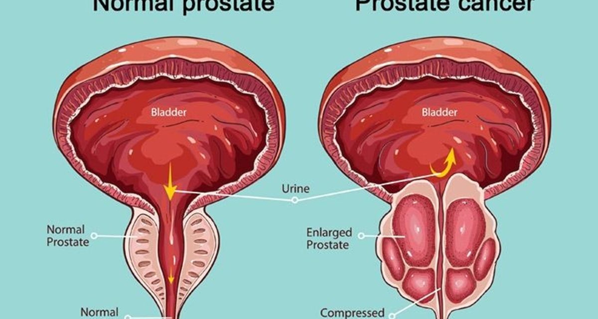 9 Gejala Kanker Prostat