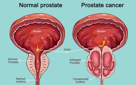 9 Gejala Kanker Prostat