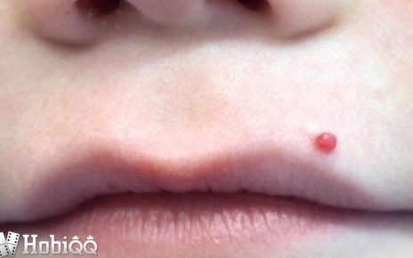 Ada Benjolan Kecil Berisi Darah di Kulit? Waspadai Pyogenic Granuloma