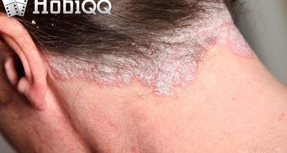 5 Jenis Psoriasis yang Mungkin Belum Kamu Ketahui