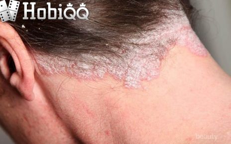 5 Jenis Psoriasis yang Mungkin Belum Kamu Ketahui