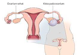 Kista Ovarium - Gejala, penyebab dan mengobati - Alodokter