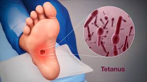 Tetanus - Symptoms, Causes, & Treatment ...